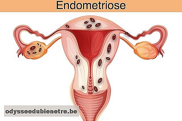 Endometriose na gravidez