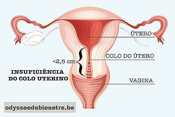 Indicação para a cerclagem uterina