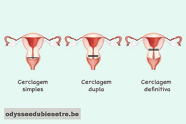Tipos de cerclagem uterina