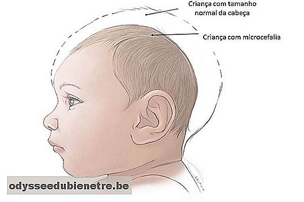 Bebê com microcefalia
