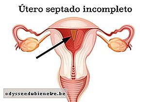 O útero septado incompleto é parcialmente dividido em dois