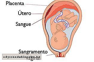 Descolamento da placenta