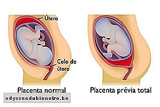 O que fazer em caso de placenta prévia