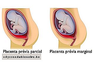 O que fazer em caso de placenta prévia