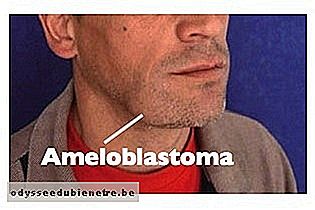 Ameloblastoma na mandíbula