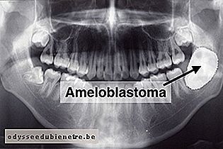 Raio X de ameloblastoma