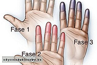 Alteração da cor da mão na Doença de Buerger