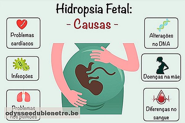 Hidropsia fetal - Doença rara que causa aborto