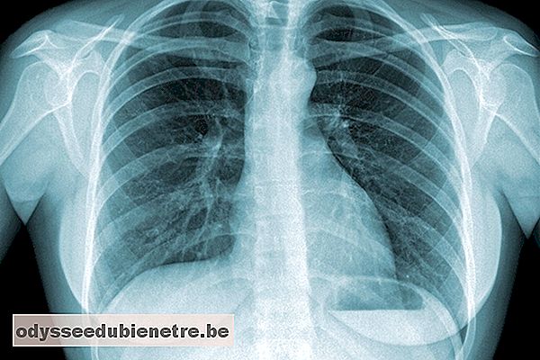 Como é feito o tratamento da tuberculose