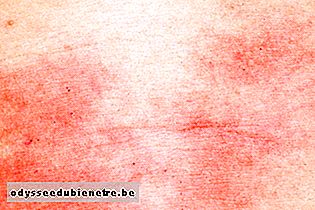 Dermatite alérgica no pescoço