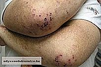 Duhring: uma dermatite especial
