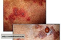 Duhring: uma dermatite especial