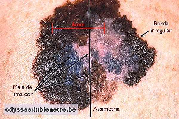 Como identificar um melanoma