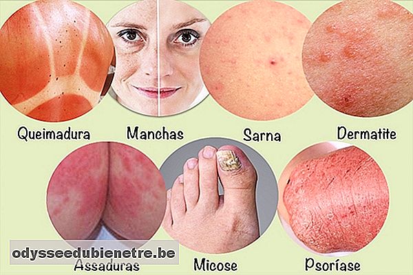 Pomadas para os 7 problemas de pele mais comuns