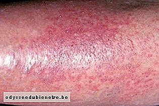 Dermatite de Estase