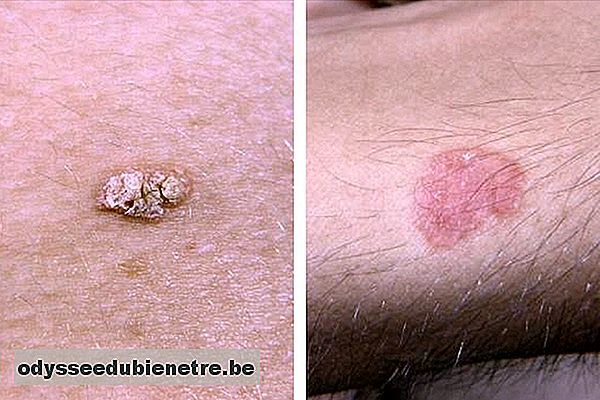 Tratamento para câncer de pele