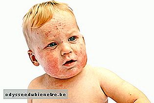 Quais são os sintomas que indicam dermatite atópica