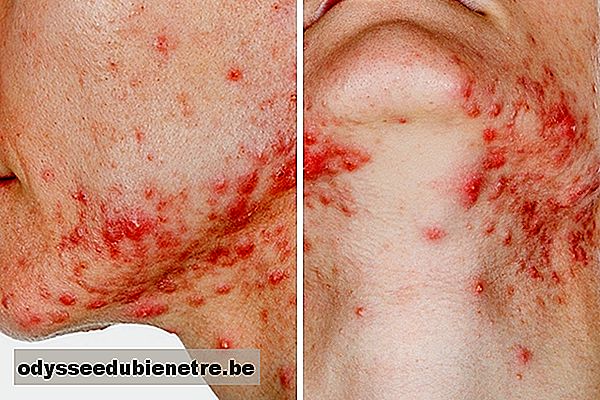 O que causa e como tratar a acne fulminante
