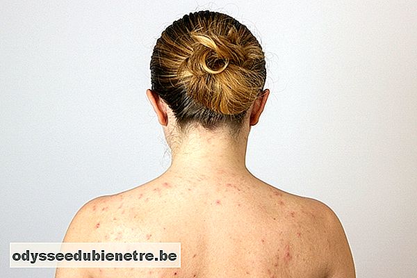 O que causa e como tratar a acne nas costas