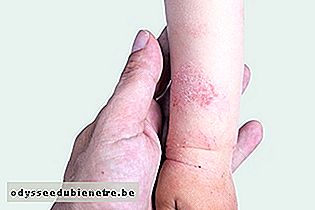 Dermatite no bebê