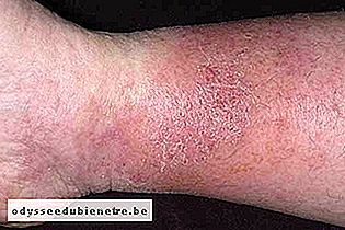 4. Dermatite ocre