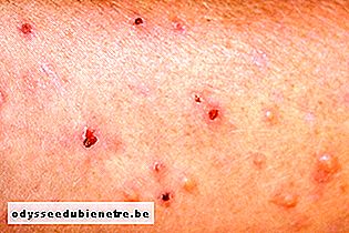 3. Dermatite herpetiforme