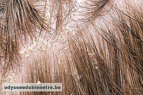 O que é a Micose no couro cabeludo e como tratar