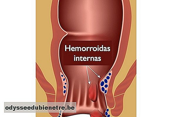 Localização da hemorróida