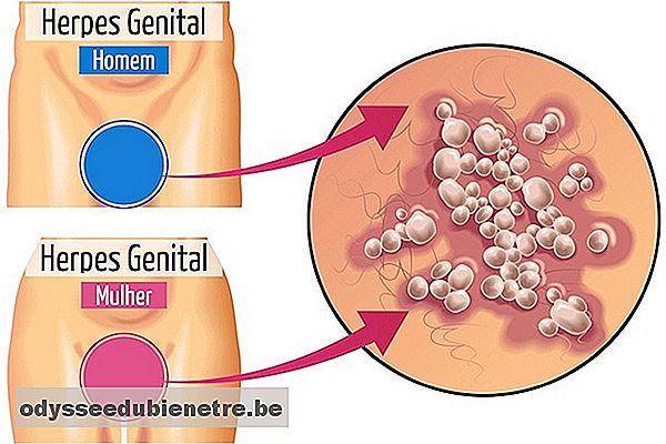 Sintomas de herpes genital