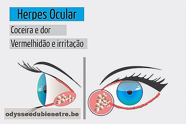 Sintomas de herpes nos olhos