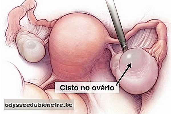 Sintomas de cisto no ovário