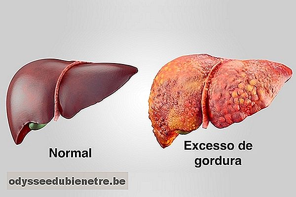 Sintomas de Gordura no Fígado e como eliminar