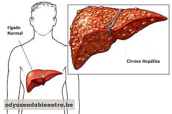 Sintomas de cirrose hepática