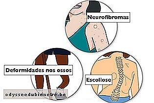 Sintomas da neurofibromatose do tipo 1