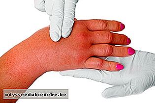 Inchaço das mãos: sintoma de esclerodermia localizada