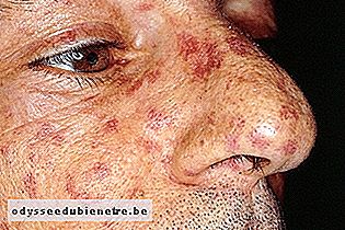 Manchas vermelhas no rosto: sintoma de esclerodermia sistêmica