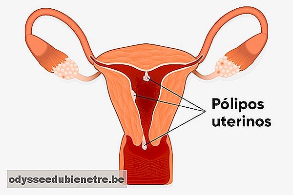Sintomas de pólipo uterino